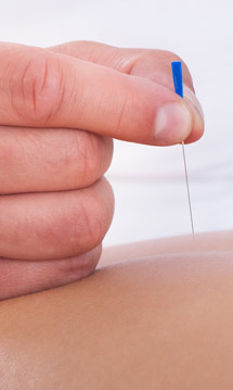 Acupuntura