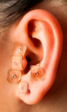 Auriculoterapia